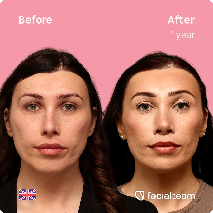Before-and-after portrait showing facial improvements after 1 year; subtle contouring and smoother skin against pink background (UK flag & Facialteam logo).
