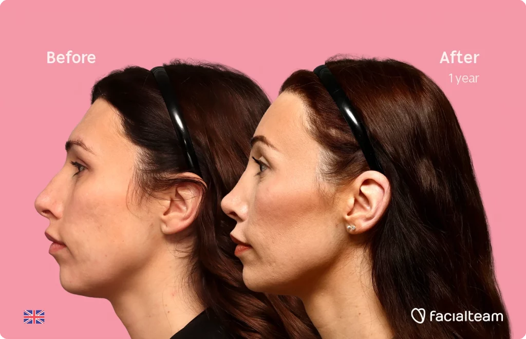 Before and after side-by-side profile of a woman after one year of cosmetic treatment; pink background with 'Before' on the left and 'After 1 year' on the right, facialteam logo in the corner.