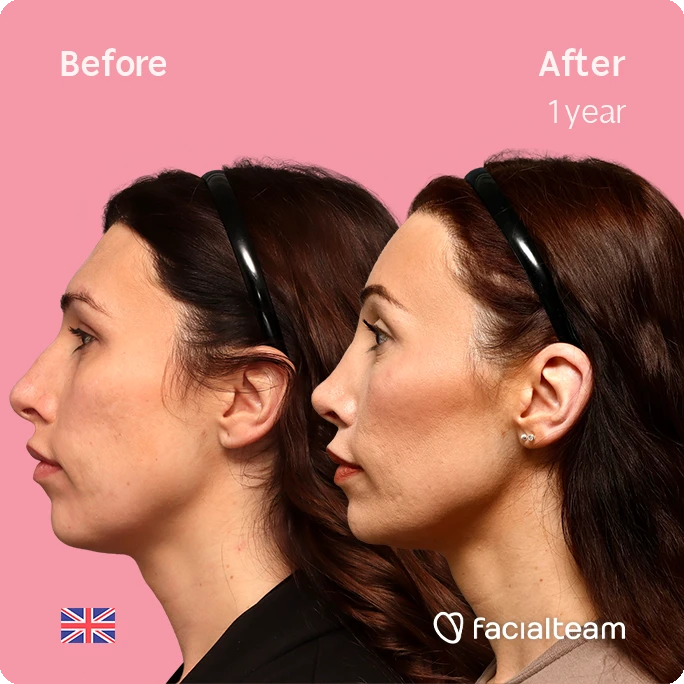 Side-by-side profile: before (left) and after one year (right) showing a defined jawline and cheeks, pink background, Fac ialteam logo.