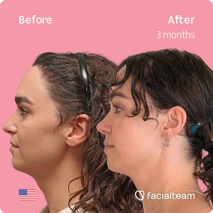 Side-by-side before-and-after headshots showing a 3-month facial transformation on a pink background with the Facialteam logo in the corner.