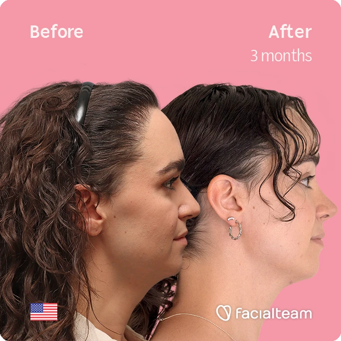 Side-by-side profile showing a woman before and after treatment (3 months); left with fuller hair, right with neater hair and improved jawline on a pink background. FaciaIteam branding at bottom.