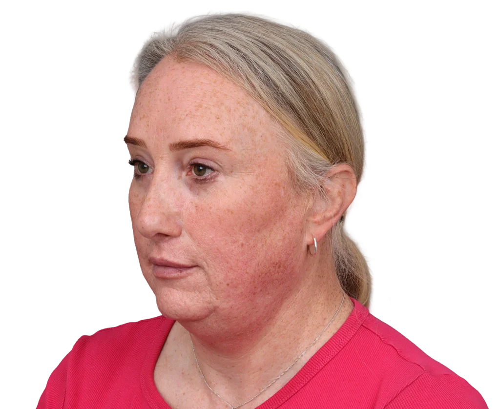 Side profile of a middle-aged woman with red, freckled cheeks wearing a pink shirt and a silver necklace.