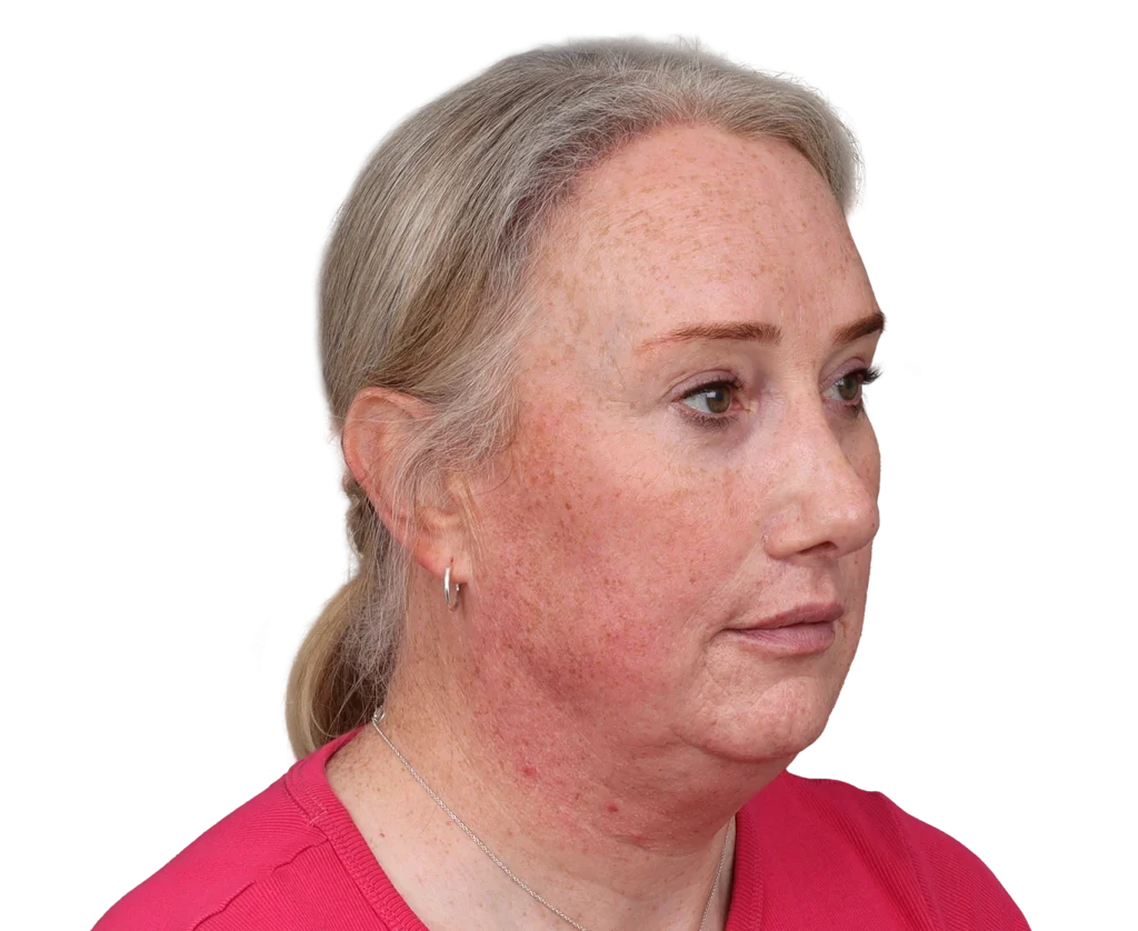 Close-up of a middle-aged woman with fair skin showing facial redness and freckles on the cheeks and jawline, in a pink shirt side profile.