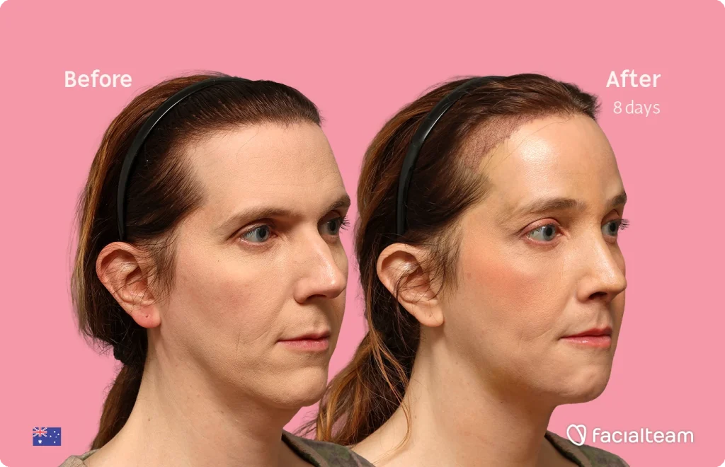 Side-by-side portraits of a woman with a headband on a pink background, labeled Before and After 8 days, showing cosmetic improvement.