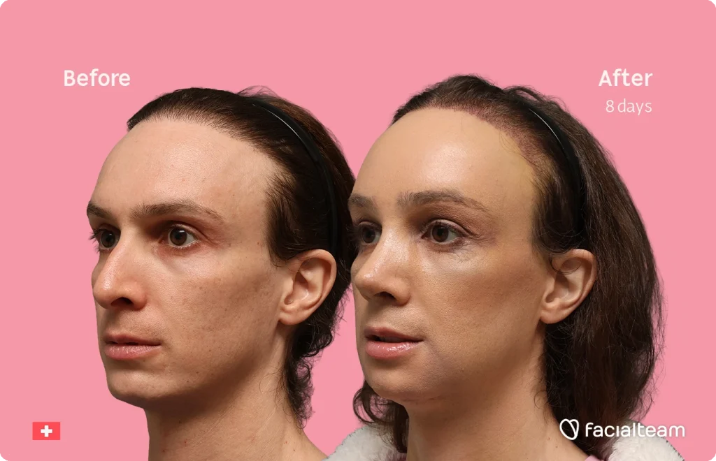 Side-by-side before-and-after portrait showing a woman’s face, left labeled 'Before' with uneven skin and right labeled 'After 8 days' with smoother skin, pink background, FacalTeam branding in corner.