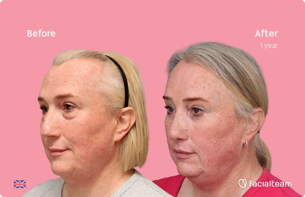Left: 'Before' portrait of a woman with blonde hair; right: 'After 1 year' portrait showing improved skin, pink background.