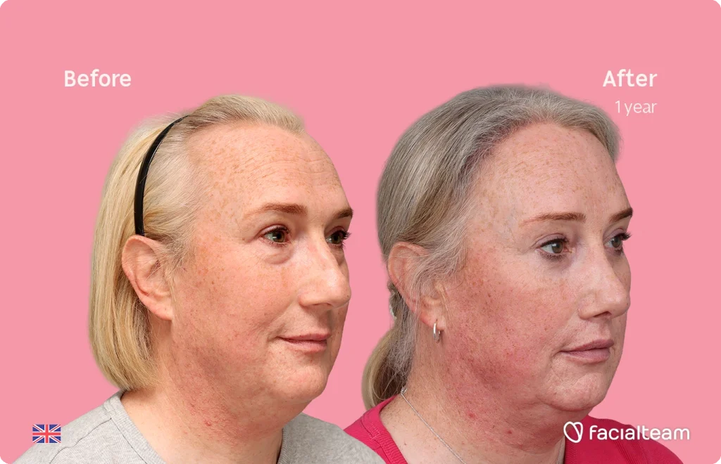 Before and after comparison showing treated woman’s face with clearer skin on the right after 1 year against a pink background.