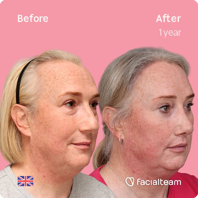 Before and after side-by-side photo of a woman's face on a pink background; after shows a tighter jawline and smoother skin at one year. Facialteam watermark.