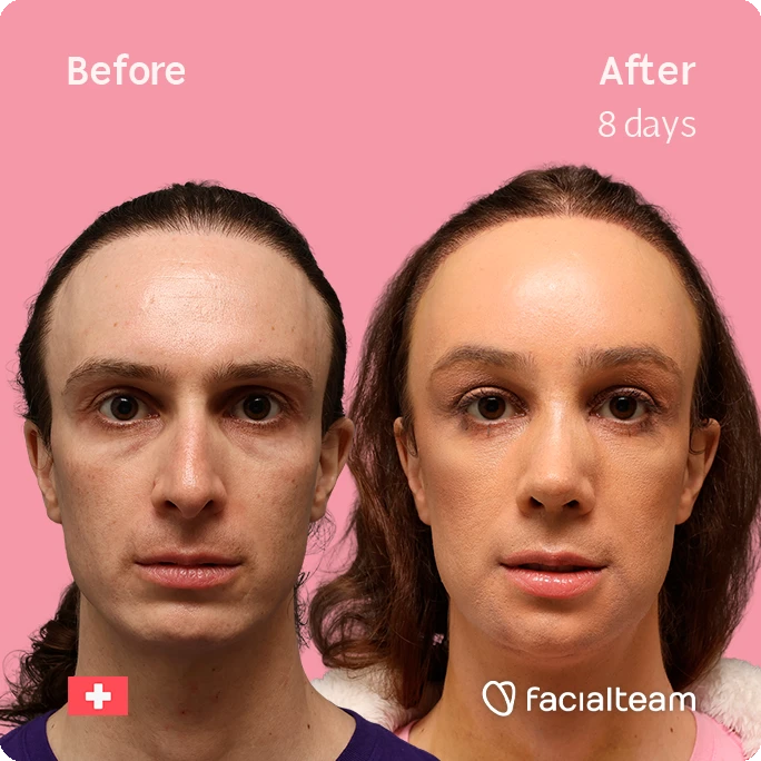 Side-by-side close-up of a person’s face before (left) and after 8 days of treatment, pink background, Facialteam branding visible.