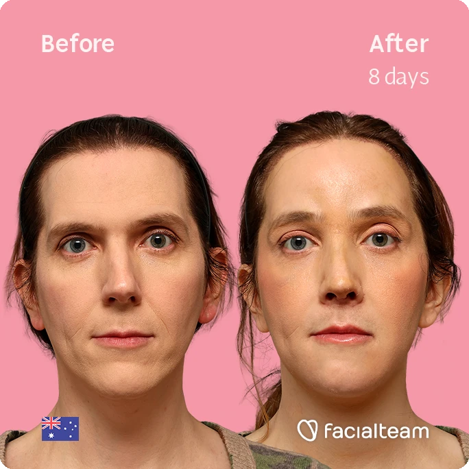 Side-by-side comparison photo showing 'Before' on the left and 'After 8 days' on the right, with a pink background; the same woman’s face appears smoother and brighter in the after image. Includes Facailteam logo and an Australian flag in the bottom corners.
