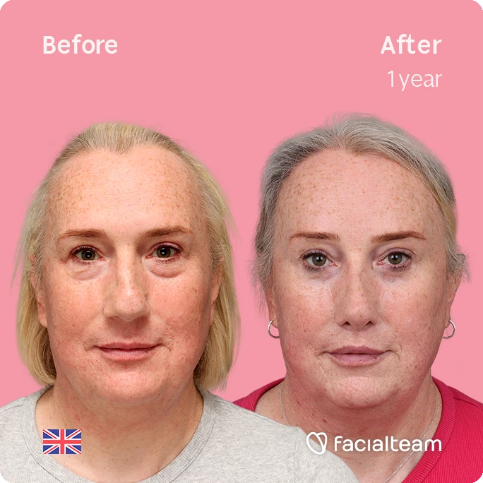 Side-by-side photos labeled 'Before' and 'After 1 year' of a freckled woman on a pink background; after image shows smoother, lighter skin around the cheeks and eyes; Facialteam logo bottom right.