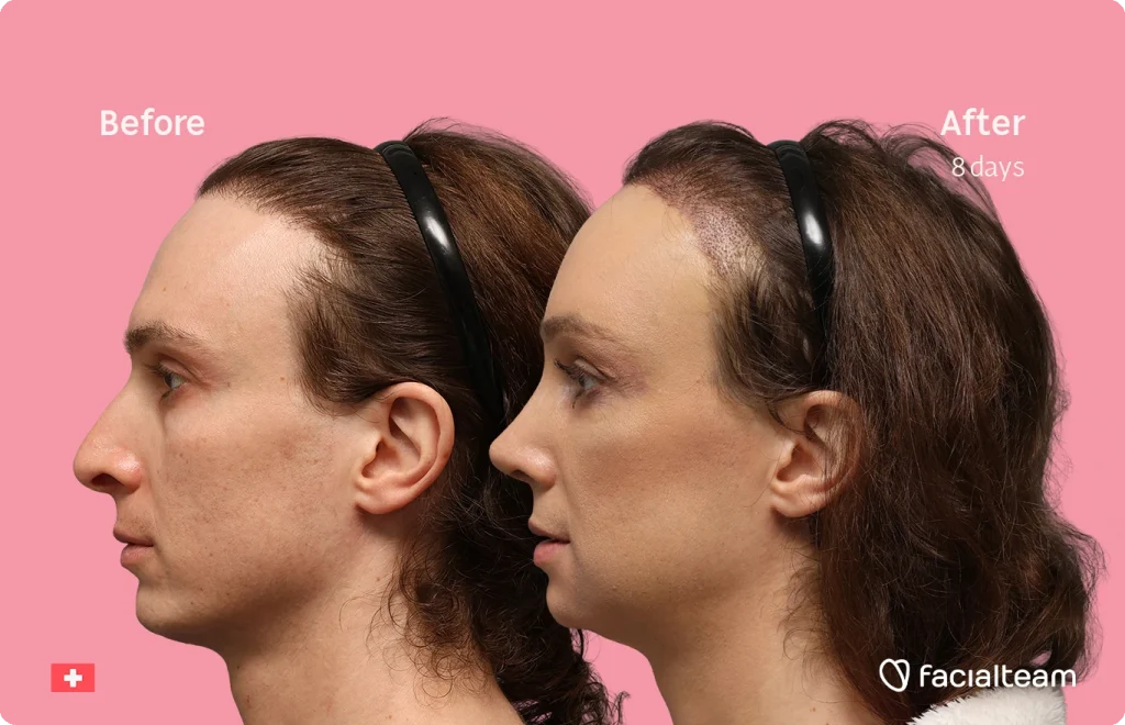 Side-by-side profile of a woman before and after cosmetic treatment, 8 days apart, pink background.