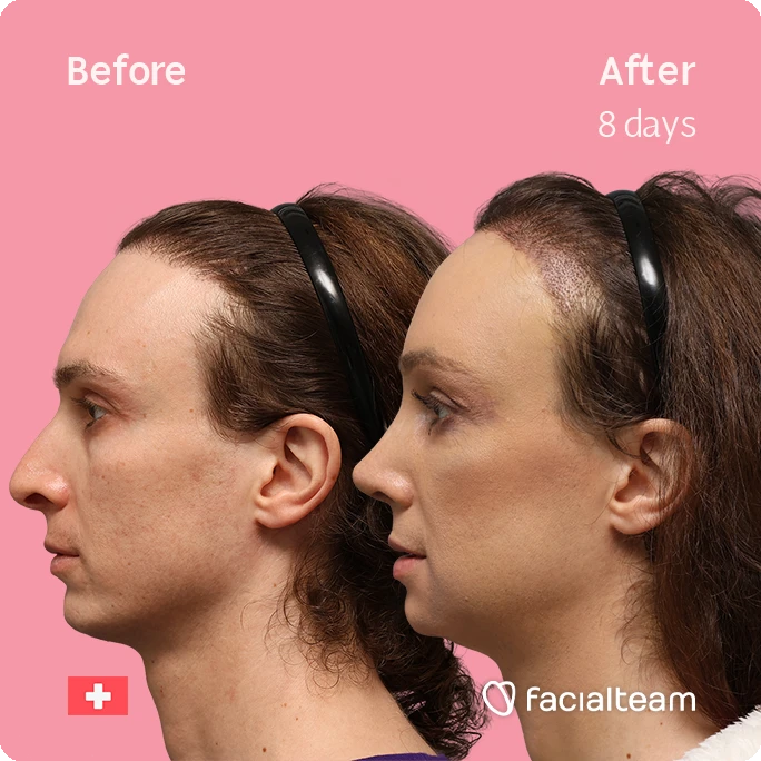 Side-by-side profile of a woman's face before (left) and eight days after a facial treatment, with a pink background and branding from Facailteam (Facialteam) at the bottom right.