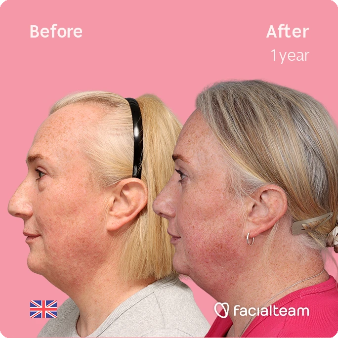Side-by-side profile photos showing a one-year facial rejuvenation result: left 'Before' with freckled skin, right 'After' with smoother, rosier skin on a pink background.