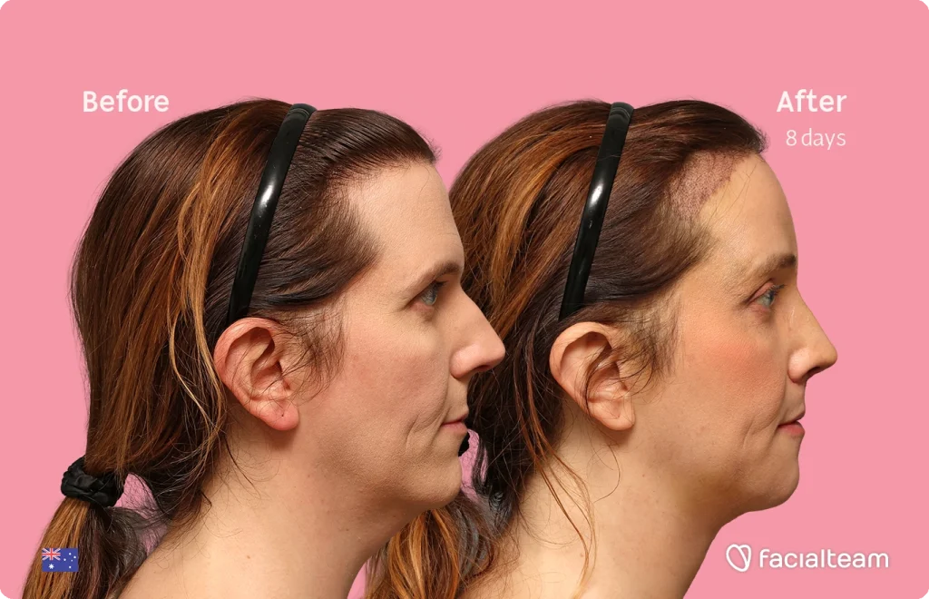 Side-by-side before-and-after portrait showing a woman's jawline and neck contour improvement after treatment, 8 days post, pink background.