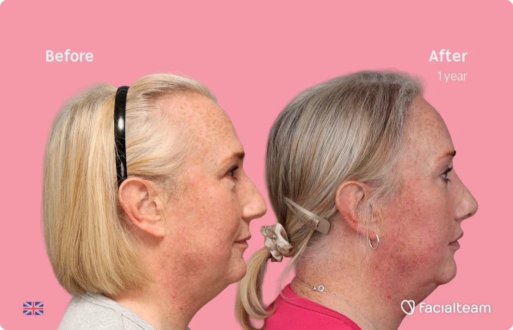Side-by-side profile: left 'Before' a woman with fuller neck; right 'After' after one year showing improved jawline and neck, pink background.