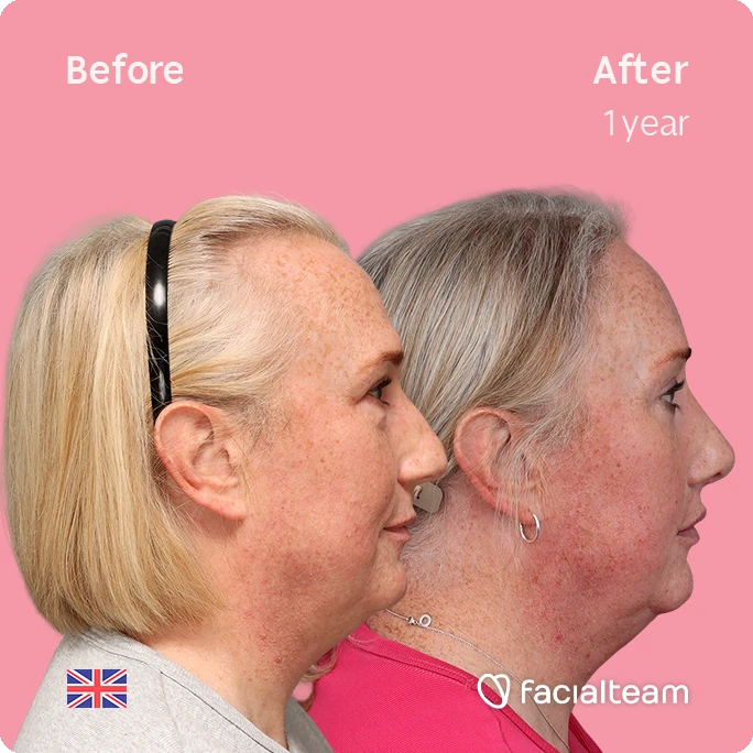 Side-by-side profile of a woman before and after 1 year of treatment, showing reduced jowls and a tighter neck against a pink background (Facialteam logo, UK flag).