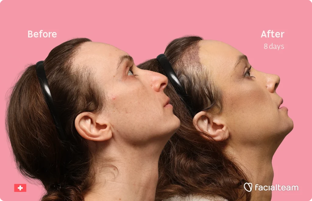 Side-by-side profile of a woman wearing headphones, labeled 'Before' (left) and 'After 8 days' (right) against a pink background; used to show cosmetic improvement with facialteam.
