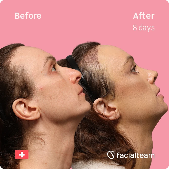 Before-and-after side-profile photos of a woman showing facial contour improvement; pink background with 'Before' and 'After 8 days' labels and the Facialteam logo.