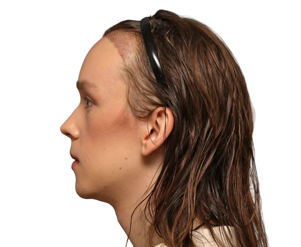 Side profile of a young woman with a healed scar along the hairline on her left forehead, wearing a black headband.