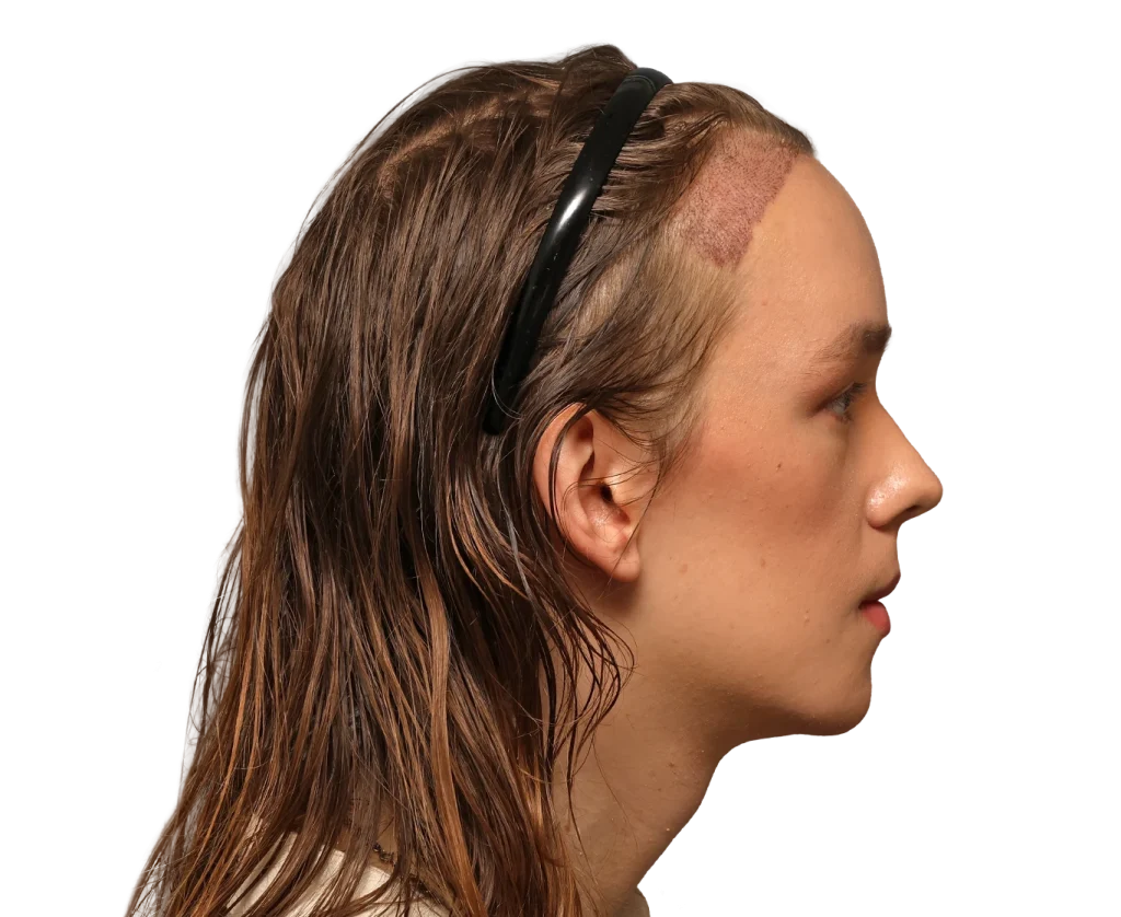 Side profile of a young person with a shaved scar on the temple area and wearing a black headband, view from the right side.