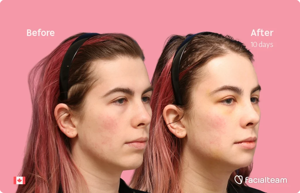 Side-by-side portrait of a woman with pink hair showing Before and After (10 days) with pink background.