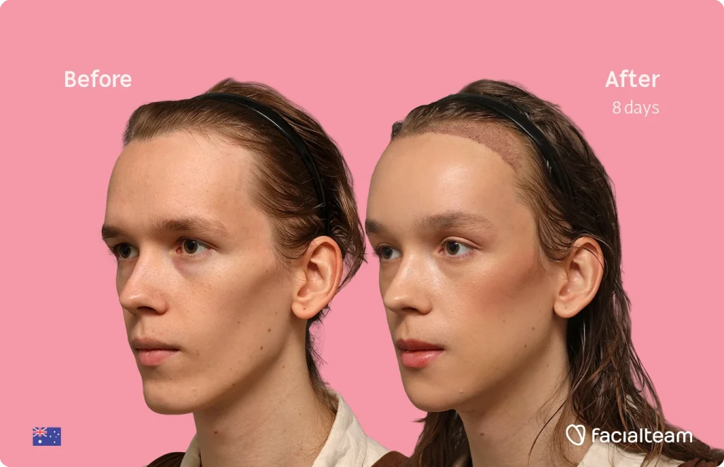Before and after comparison of a woman's hairline restoration on a pink background; left shows pre-treatment, right shows post-treatment at 8 days (Facialteam)