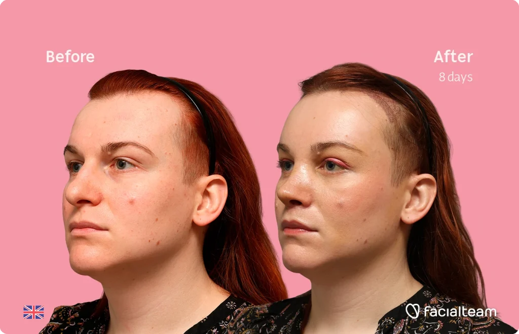 Before and after facial treatment comparison: pink background, woman with red hair shows clearer skin after 8 days (Before on left, After on right).