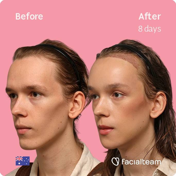 Side-by-side portrait of a woman before (left) and after eight days of treatment, showing improved skin with a forehead patch in the after image, on a pink background with the Facialteam logo.