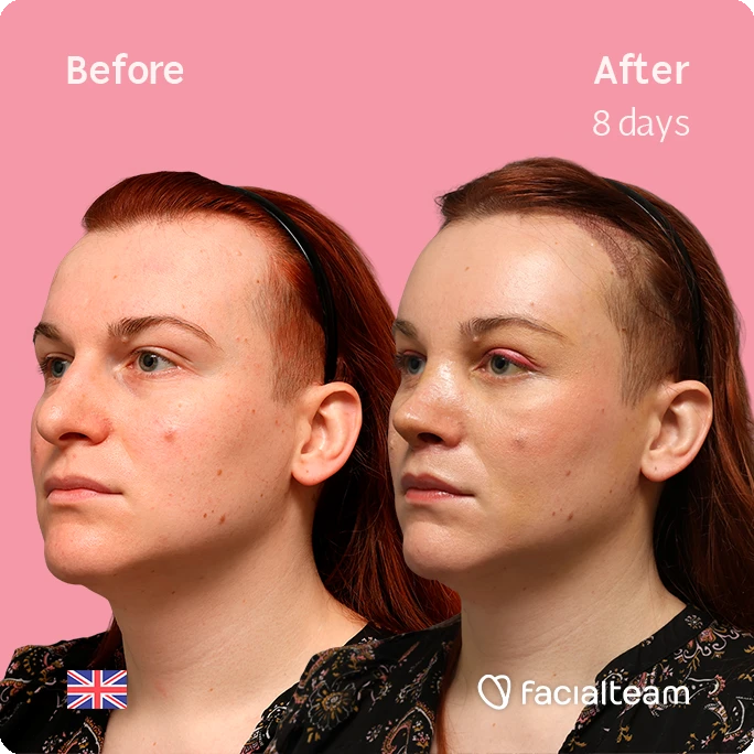 Side-by-side before-and-after portrait of a woman: left shows acne-prone skin before treatment, right shows clearer skin after 8 days, on pink background with UK flag and Facialteam logo.
