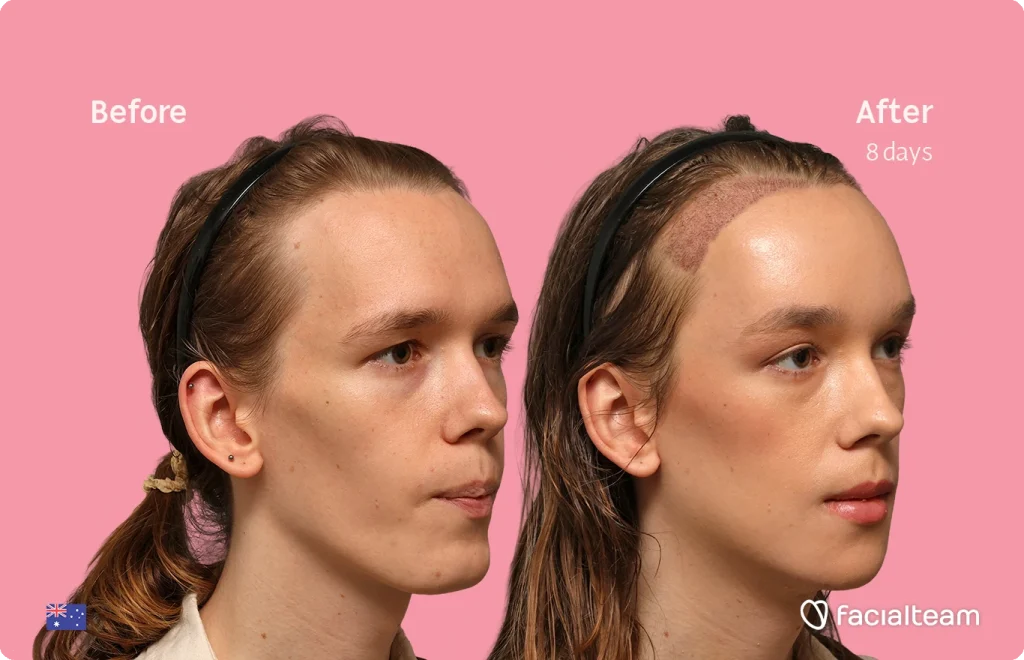 Side-by-side before and after of a woman's face after treatment; after image shows smoother, more even skin tone (8 days).Pink background with 'Before' and 'After' labels on each side.
