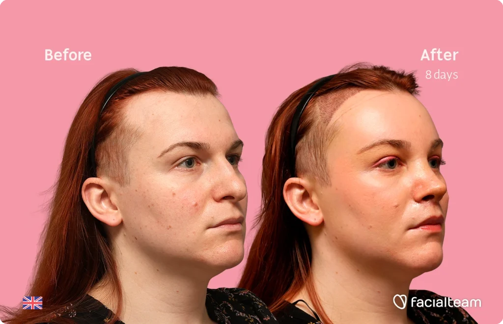 Before and after comparison: side-by-side photos of a woman's face on a pink background, eight days after treatment showing clearer skin; Facialteam logo bottom right.