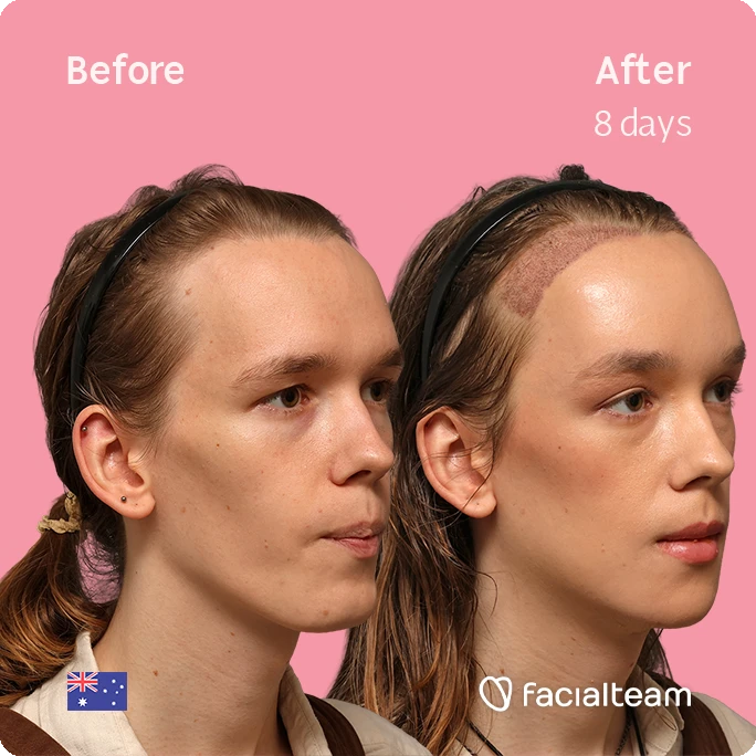 Before and after facial treatment comparison: left shows the face pre-treatment, right shows the eight-day post-treatment result with improved cheek and jaw contour; pink background, Australian flag, and Facialteam logo.