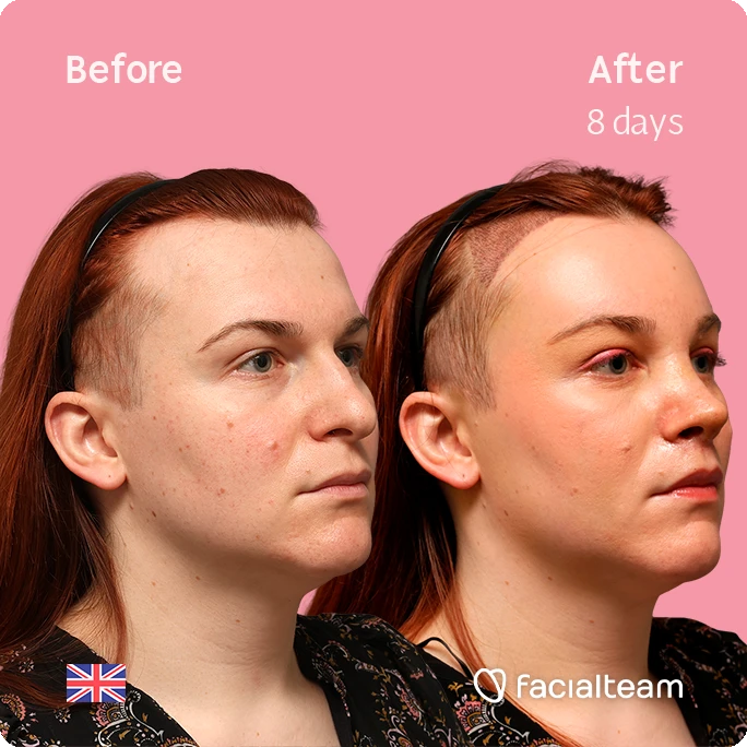 Side-by-side portrait of a woman before and after 8 days of treatment; pink background, left 'Before', right 'After 8 days' with a headband and short shaved sides.