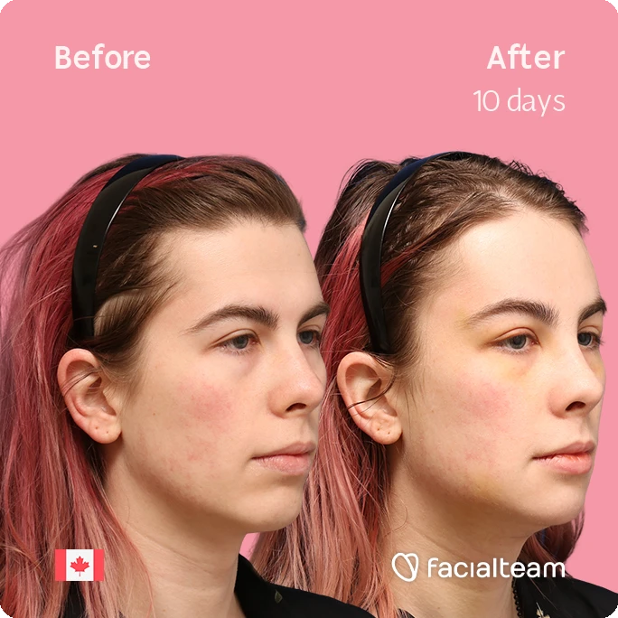 Side-by-side photo of a woman's face before and 10 days after treatment on a pink background, showing improved skin texture and reduced redness.