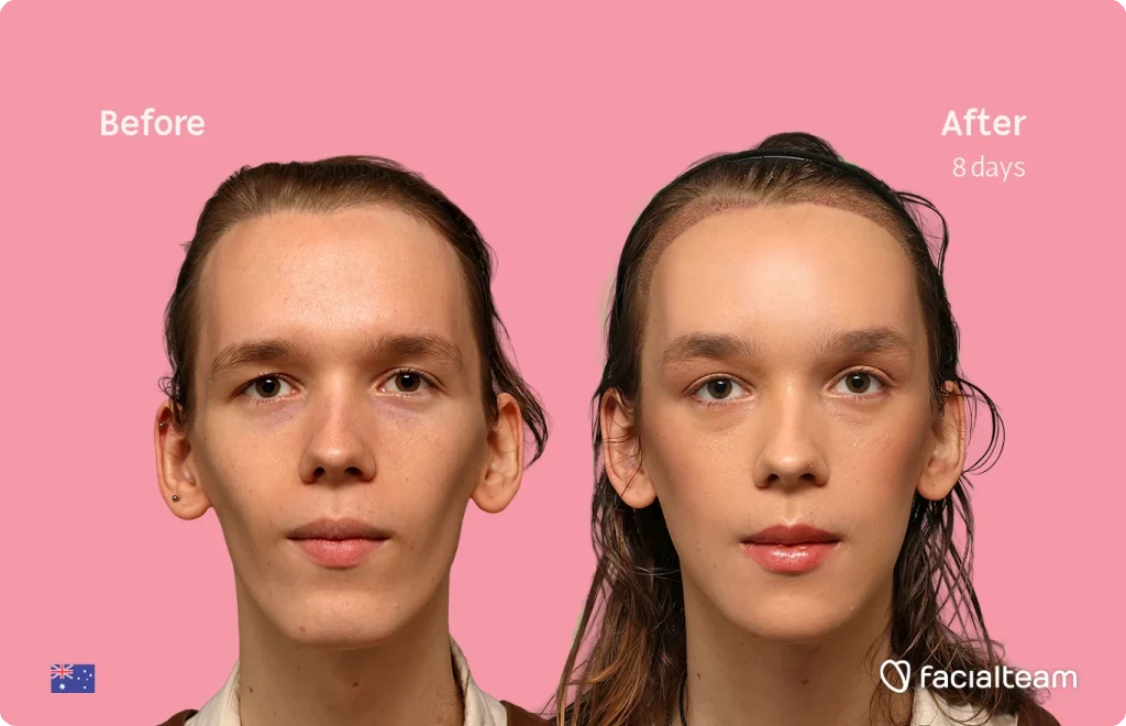 Side-by-side portrait of a woman before (left) and after 8 days of treatment on a pink background; facialteam logo bottom right.