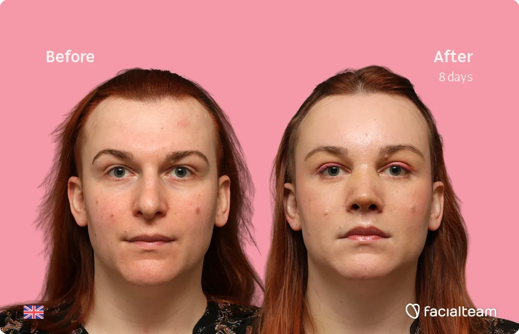 Side-by-side before-and-after photo of a woman’s face on a pink background, labeled Before and After 8 days, showing clearer skin after treatment.