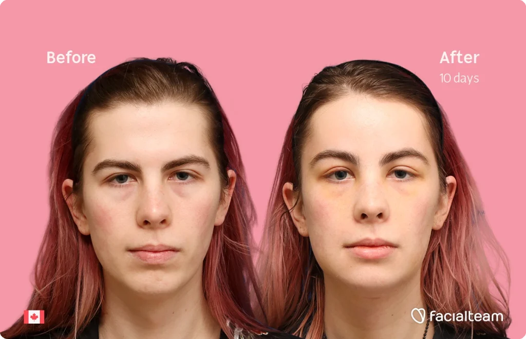 Side-by-side portraits of a woman before (left) and after 10 days (right) of treatment on a pink background, with facialteam logo bottom-right.