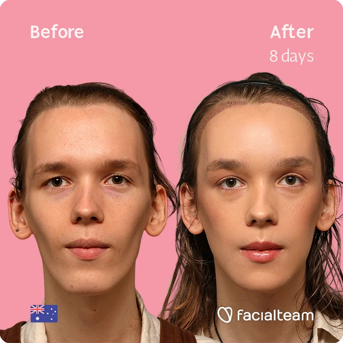 Before-and-after portrait of a woman showing facial treatment results after 8 days on a pink background; includes an Australian flag and the Facialteam logo.
