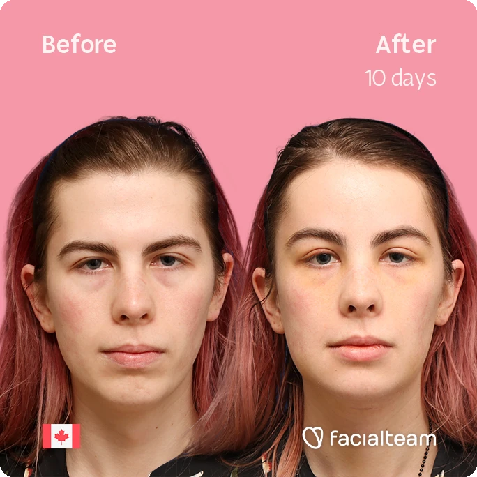 Side-by-side comparison of a woman's face labeled 'Before' and 'After 10 days' showing facial treatment results; Canadian flag icon bottom left and Facialteam logo bottom right.