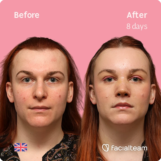 Before and after photos of a woman with acne on a pink backdrop; after 8 days, skin appears clearer; facialteam logo at bottom right.