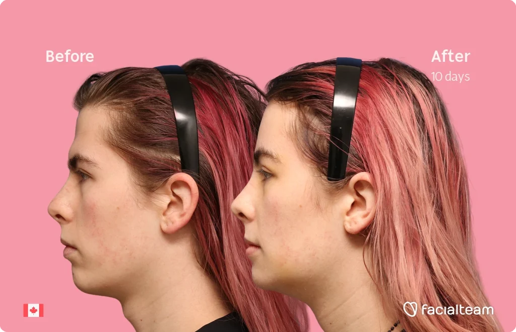 Side-by-side profile of a young woman before and after treatment, pink background, labeled 'Before' and 'After 10 days'.