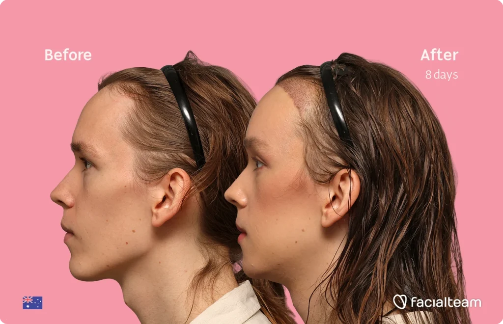 Side-by-side profile of a woman showing 'Before' on the left and 'After 8 days' on the right against a pink background; the left image shows a fuller hairline, the right image shows a newly drawn or lighter hairline area near the forehead, suggesting a treatment progress.
