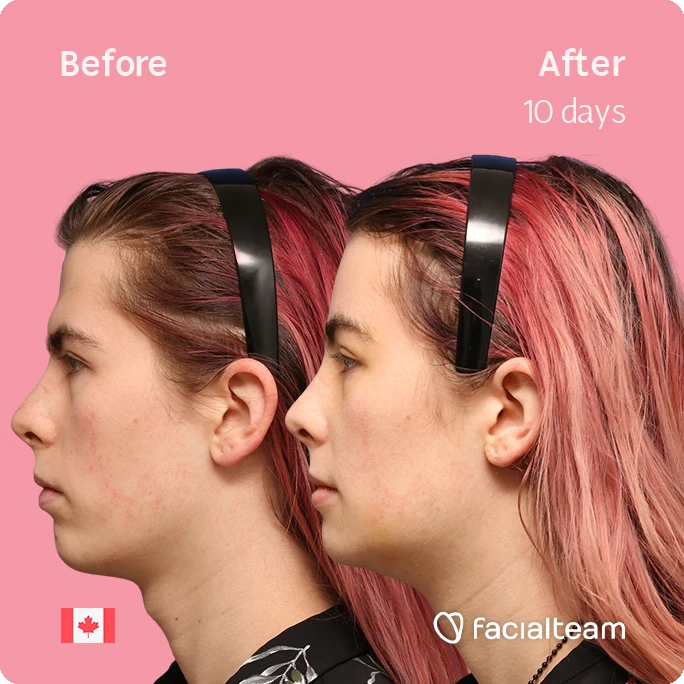 Side-by-side profile of a woman before and after 10 days of treatment; pink background, black headbands, facialteam branding, Canadian flag icon.
