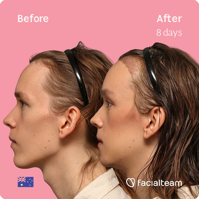 Side-by-side profile photos of a woman against a pink background, labeled Before (left) and After 8 days (right), showing treatment progress; branding by Facialteam.