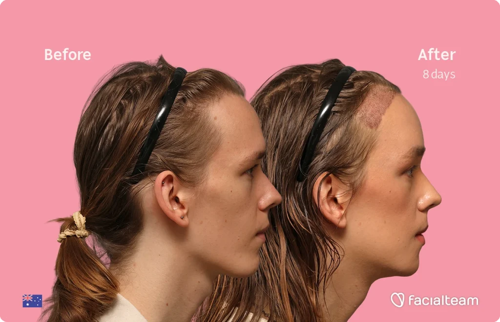 Side-by-side before and after photo of a woman’s scalp healing after a hair procedure; pink background.