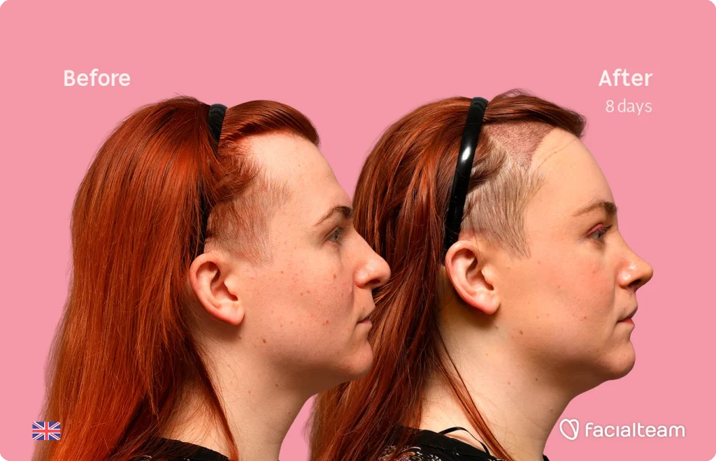 Side-by-side profile of a woman before and eight days after hair restoration, pink background, branding on corners.