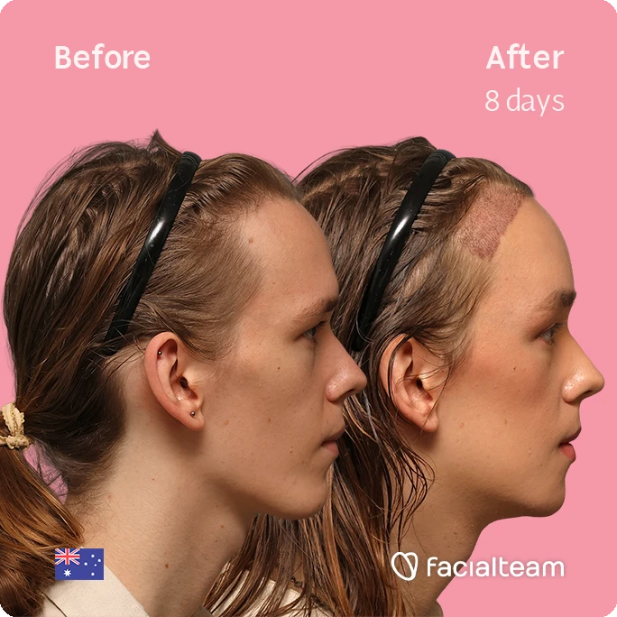 Side-by-side profile of a woman's face before and after treatment (8 days) on a pink background; left has 'Before', right 'After 8 days' with FacialTeam logo.