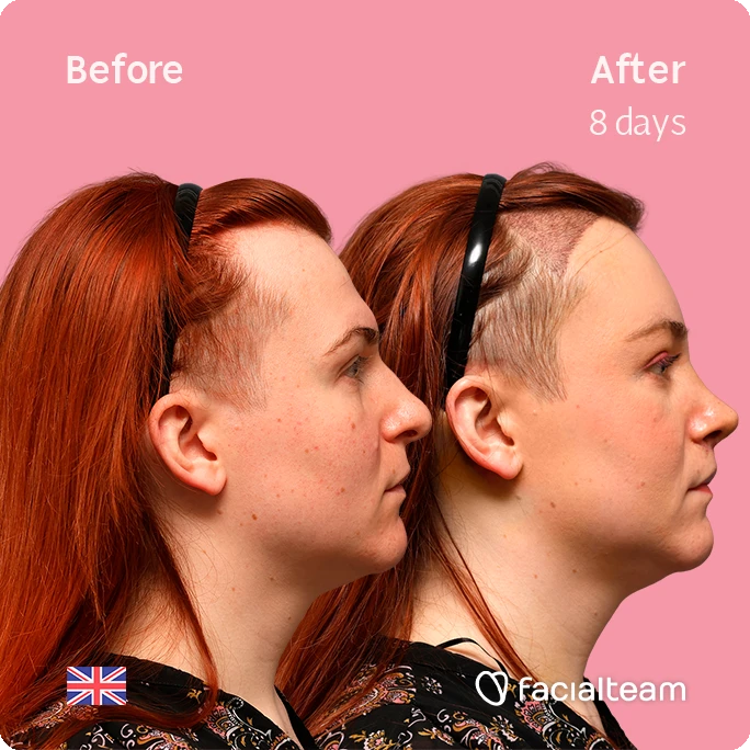 Side-by-side profile photos of a woman with red hair on a pink background, showing before (left) and after (right) 8 days of treatment (logo: facialteam).