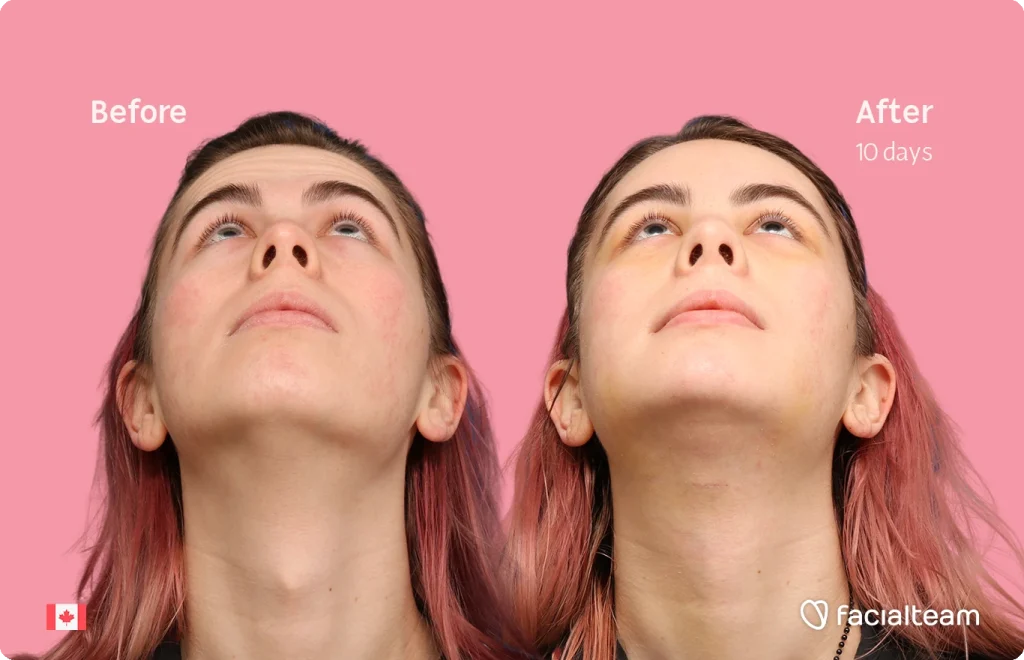 Side-by-side portraits showing a woman looking up: left labeled 'Before' and right labeled 'After 10 days' on a pink background. Canadian flag bottom-left; facalteam logo bottom-right.